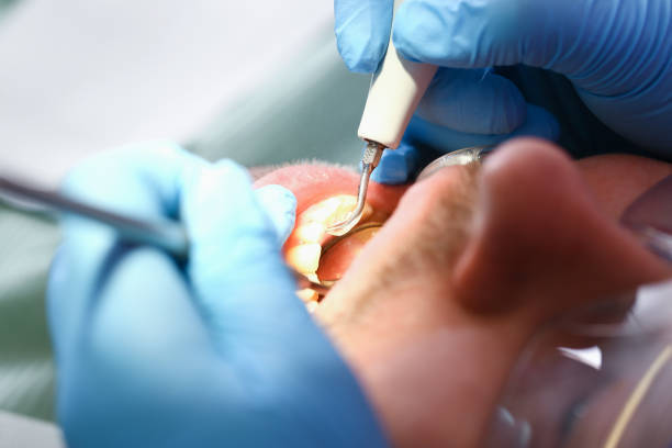 Best Emergency Tooth Extraction in Derby, KS