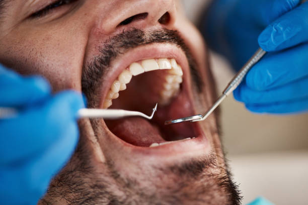 Best Emergency Wisdom Teeth Removal in Derby, KS